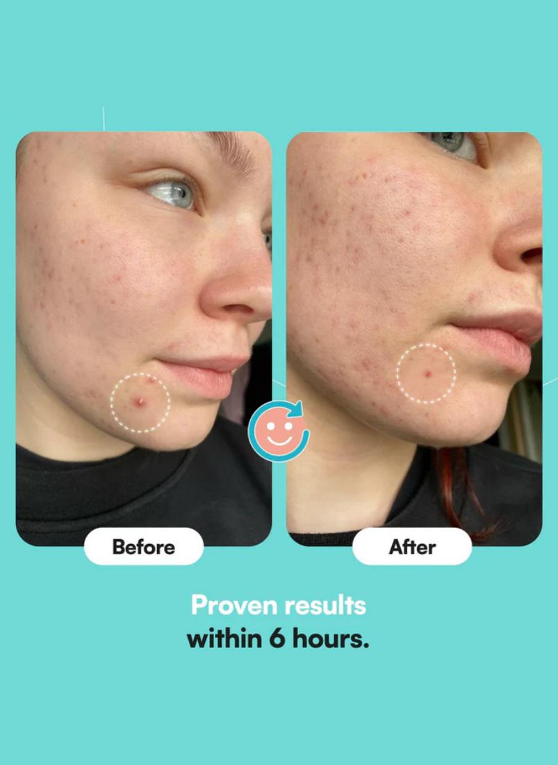 buy-skinchoice-breakout-patch-classic-travel-edition-pack-of-30_hm8